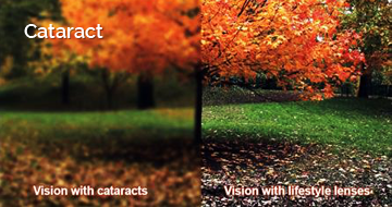 Cataract